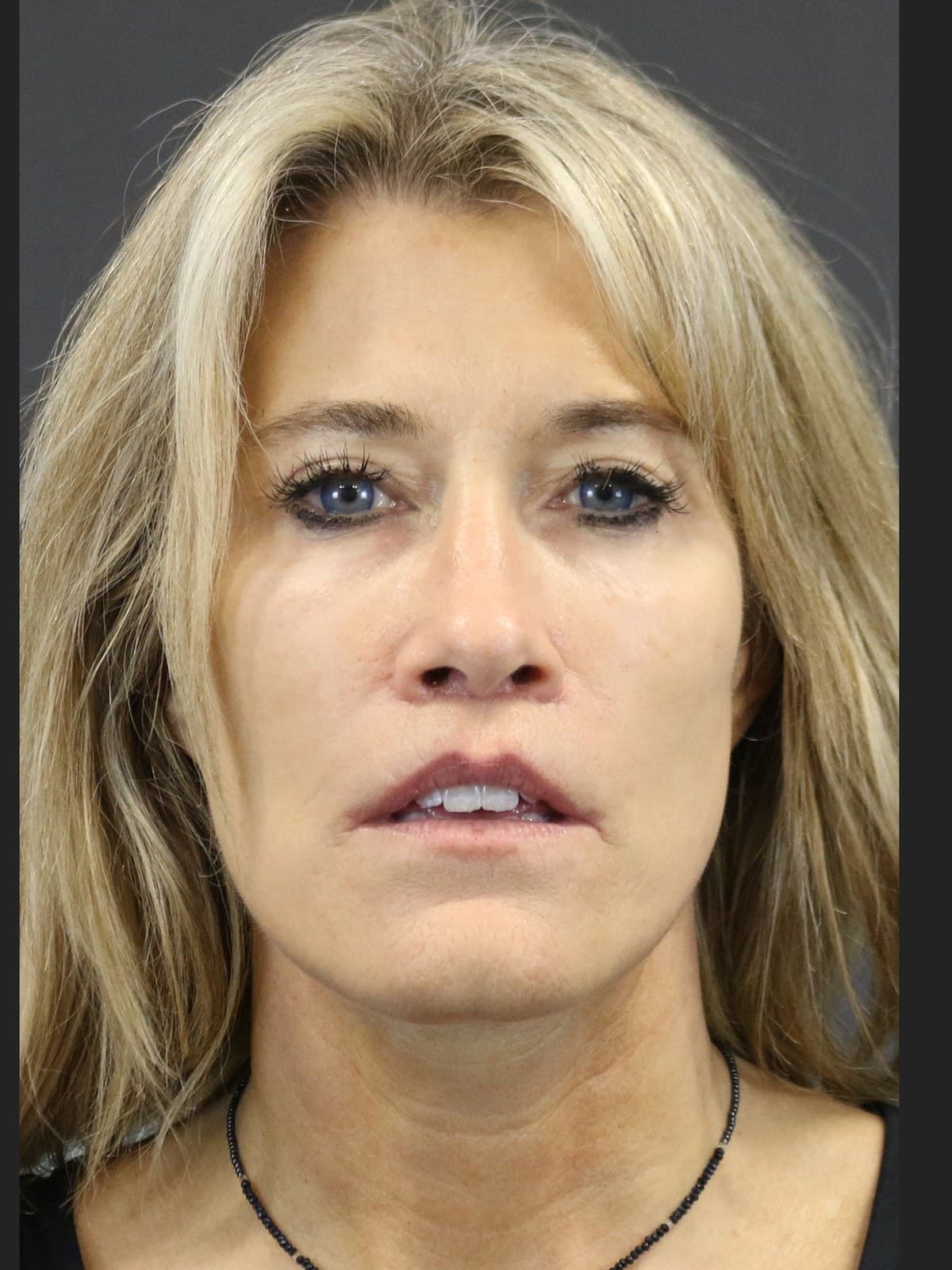 Deep plane face and neck lift, front view